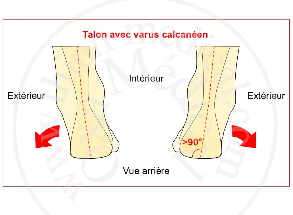Schéma de talon varus